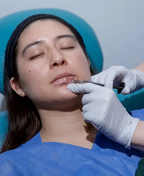Aplicación de ácido hialurónico en labios realizada por especialista en medicina estética.