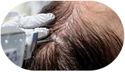 Tratamiento para alopecia y caída del cabello en clínica dermatológica en CDMX