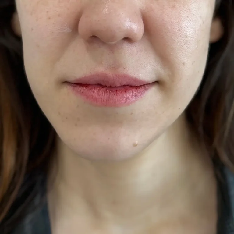 Labios antes de aumento con ácido hialurónico.