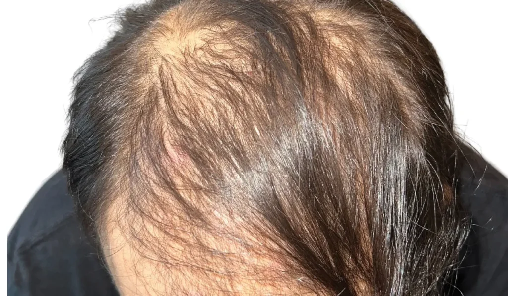 Antes del tratamiento capilar mostrando caída de cabello y baja densidad en cuero cabelludo