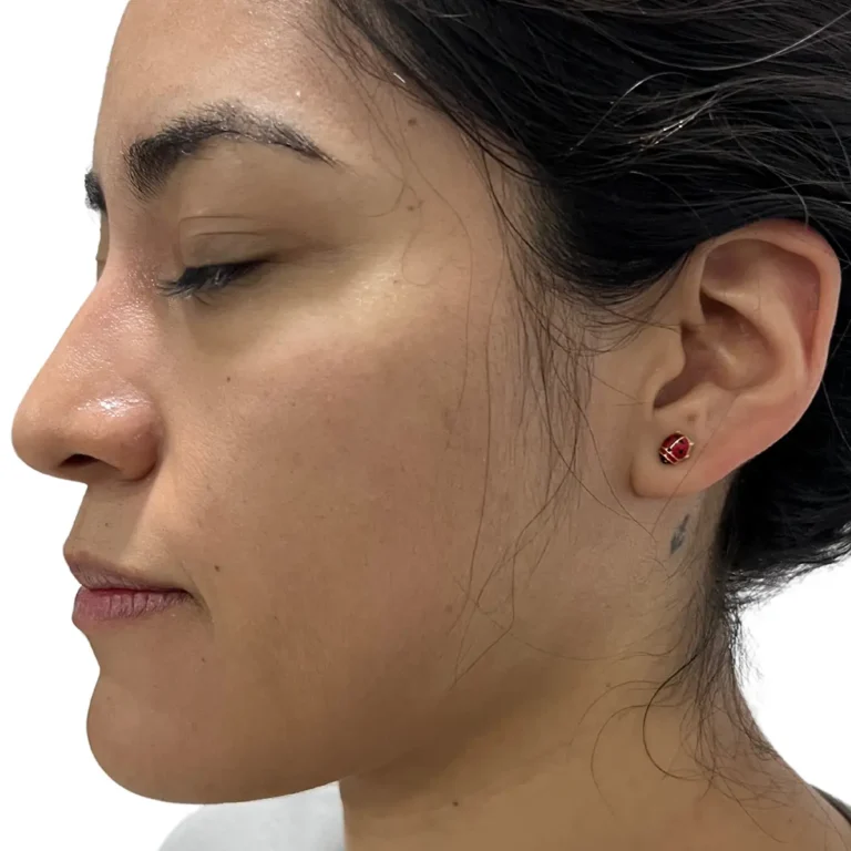 Perfil facial antes de rinomodelación con ácido hialurónico.