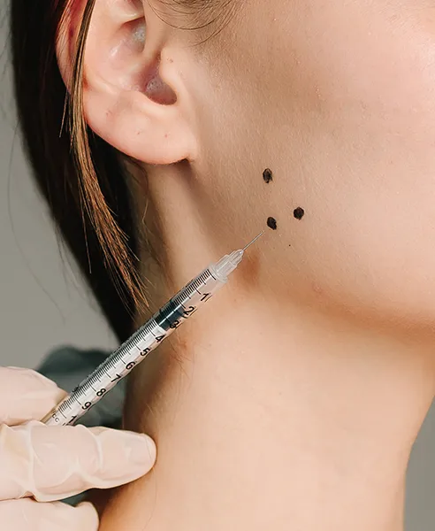 Tratamiento para bruxismo con toxina botulínica aplicado en mandíbula en clínica dermatológica en CDMX