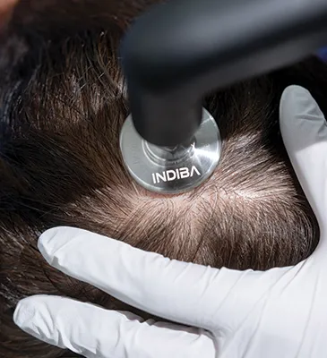 Tratamiento capilar con tecnología médica para caída del cabello en clínica dermatológica en CDMX