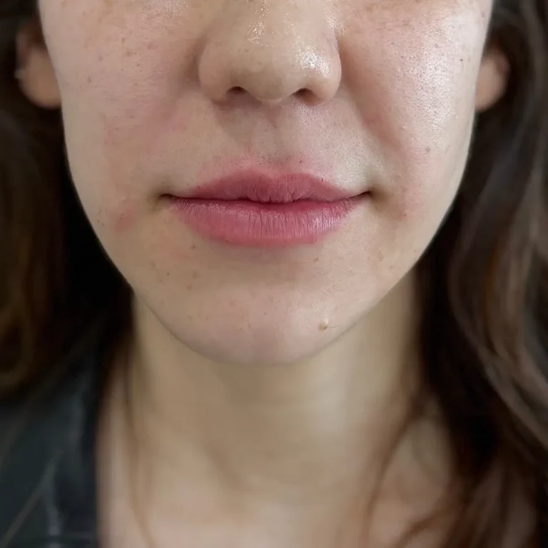 Labios después de aumento con ácido hialurónico.