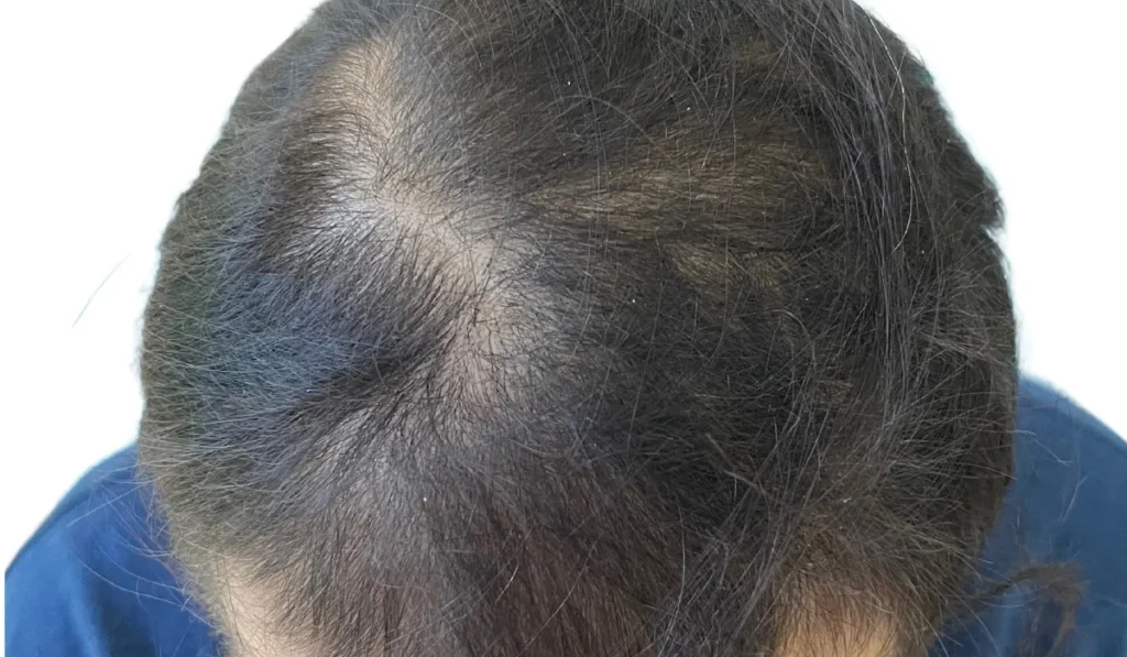 Después del tratamiento capilar con mejora en densidad y fortalecimiento del cabello