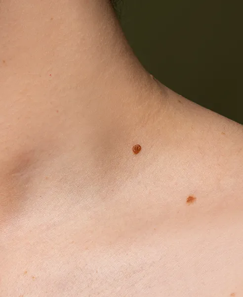 Tratamiento dermatológico para fibromas cutáneos en clínica en CDMX