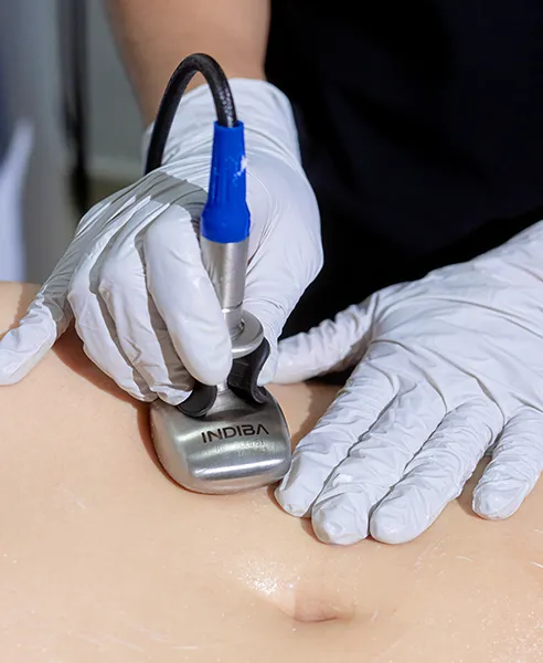 Tratamiento Indiba corporal realizado en clínica dermatológica en CDMX