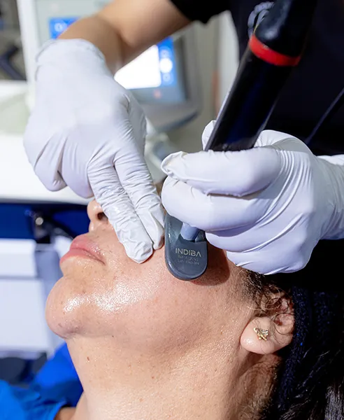 Tratamiento Indiba facial realizado en clínica dermatológica en CDMX