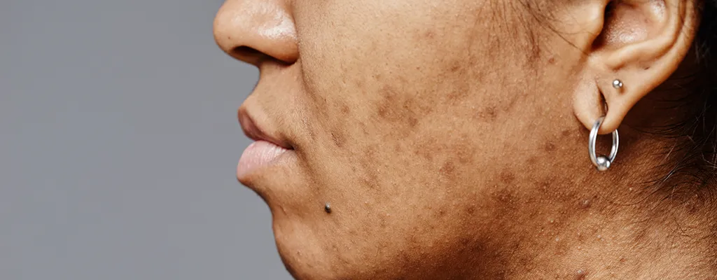 Valoración dermatológica de manchas faciales y tratamiento despigmentante en clínica dermatológica en CDMX