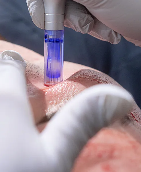 Tratamiento Mesoject facial realizado en clínica dermatológica en CDMX