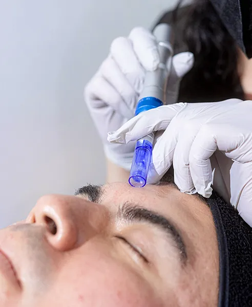 Tratamiento de micropunciones con exosomas realizado en clínica dermatológica en CDMX