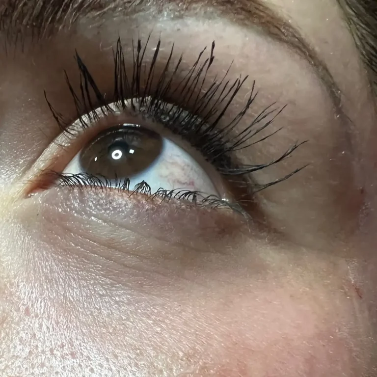 Resultado previo en contorno ocular antes de tratamiento facial con NCTF.