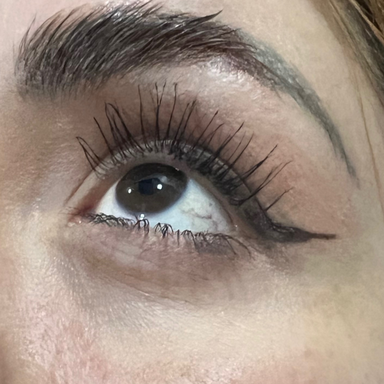 Resultado en contorno ocular después de tratamiento facial con NCTF.