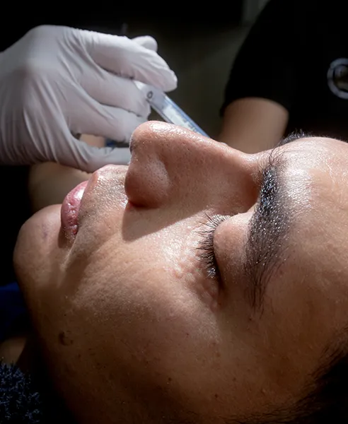 Aplicación de NCTF para biorevitalización facial en CDMX