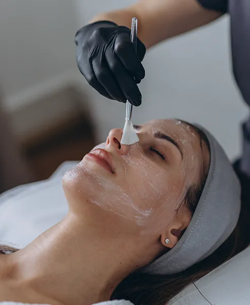 Aplicación de peeling químico facial en clínica dermatológica en CDMX