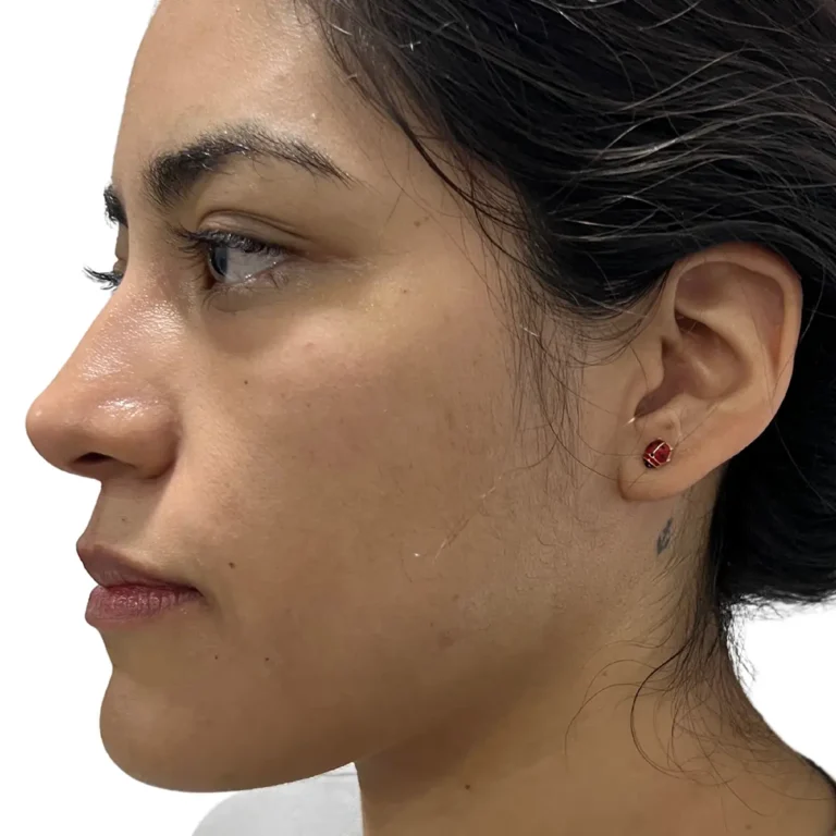 Perfil facial después de rinomodelación con ácido hialurónico.