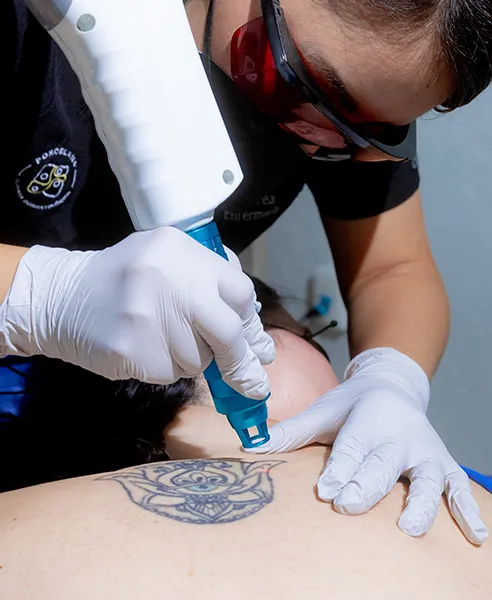 Tratamiento dermatológico para eliminación de tatuajes en clínica en CDMX