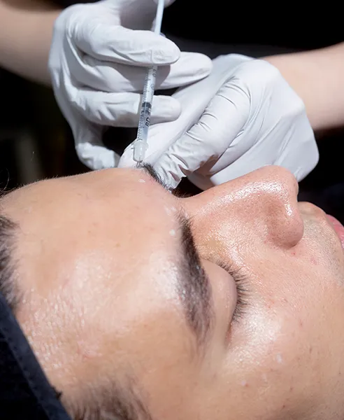 Aplicación de toxina botulínica en frente realizada por dermatóloga en clínica dermatológica en CDMX